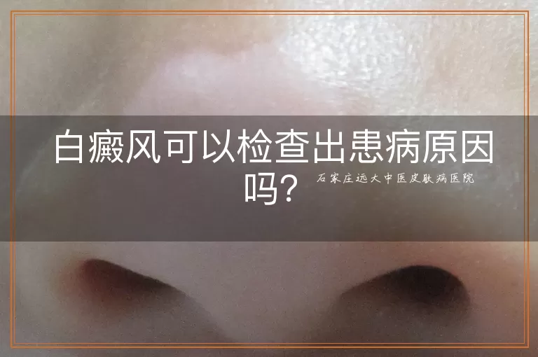 白癜风可以检查出患病原因吗？