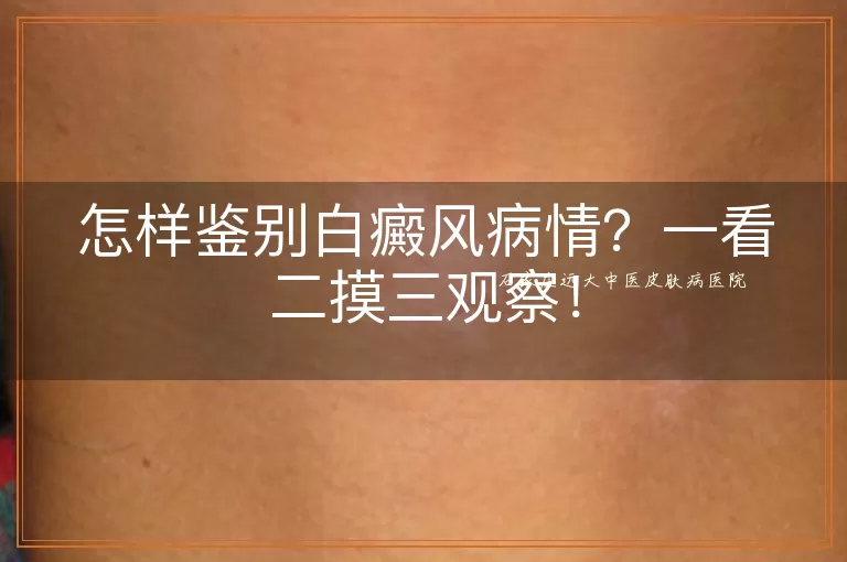 怎样鉴别白癜风病情？一看二摸三观察！