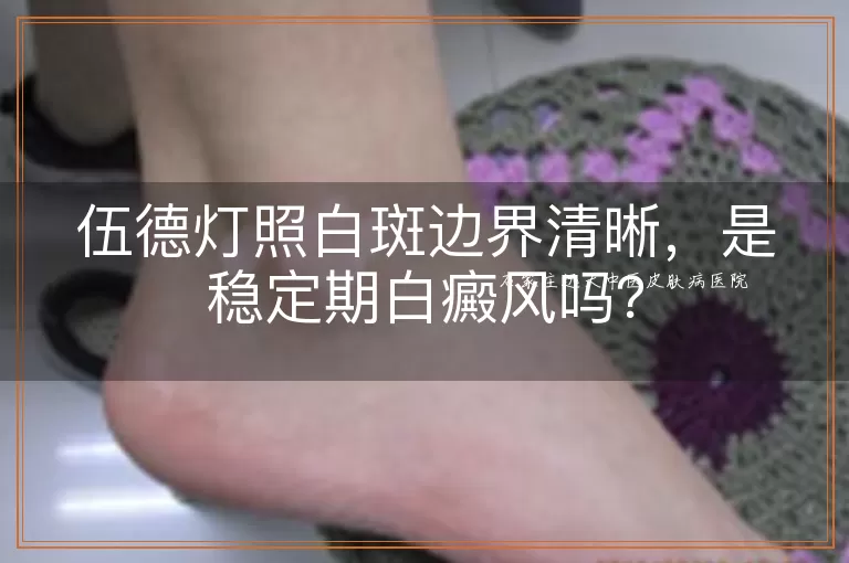 伍德灯照白斑边界清晰，是稳定期白癜风吗？