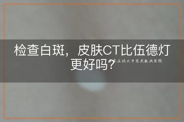 检查白斑，皮肤CT比伍德灯更好吗？