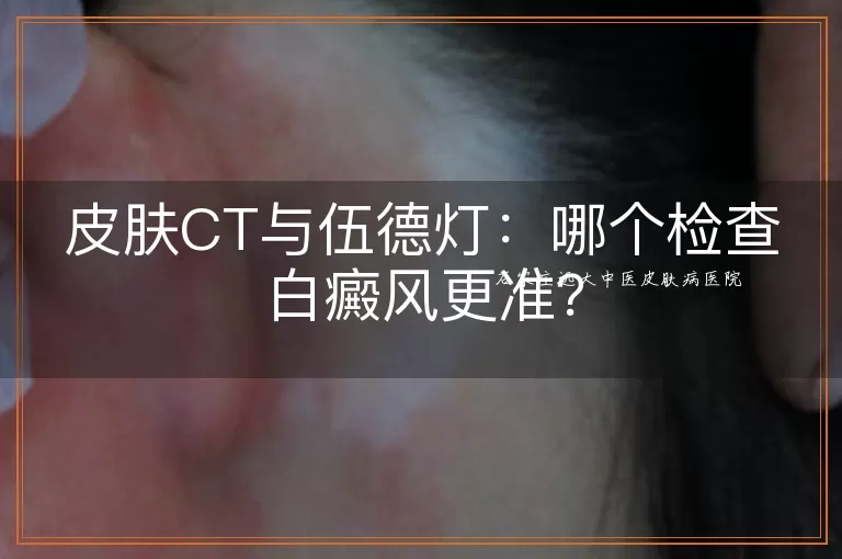皮肤CT与伍德灯：哪个检查白癜风更准？