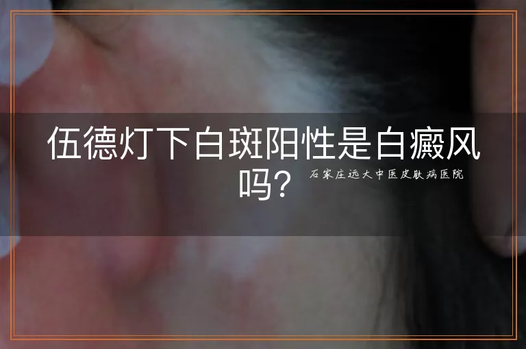 伍德灯下白斑阳性是白癜风吗？