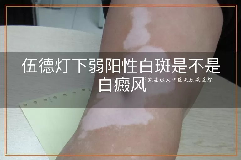 伍德灯下弱阳性白斑是不是白癜风