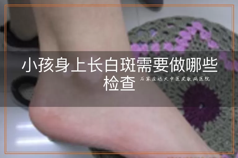 小孩身上长白斑需要做哪些检查