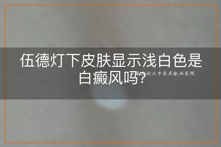 伍德灯下皮肤显示浅白色是白癜风吗？