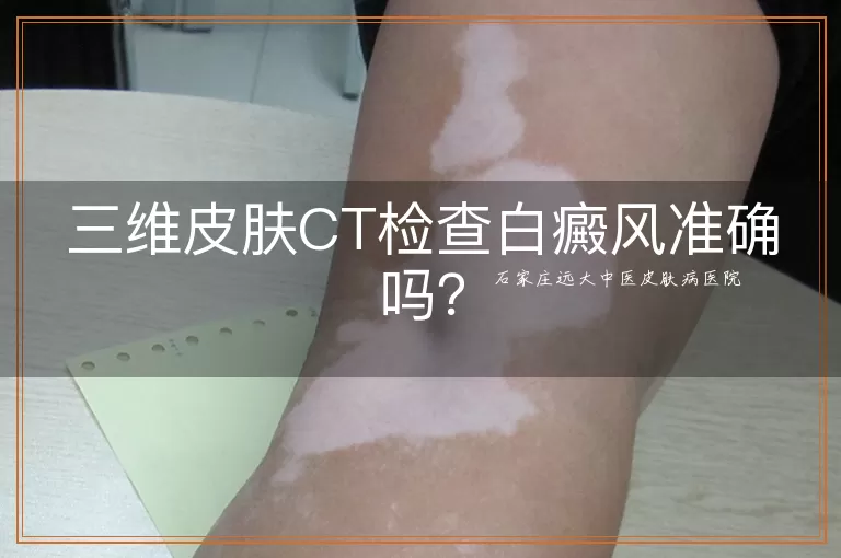 三维皮肤CT检查白癜风准确吗？