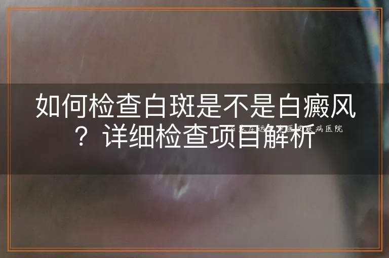 如何检查白斑是不是白癜风？详细检查项目解析