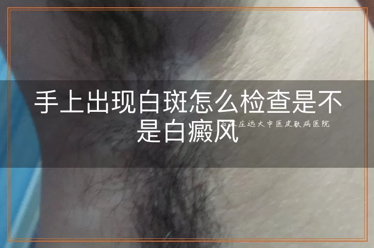 手上出现白斑怎么检查是不是白癜风