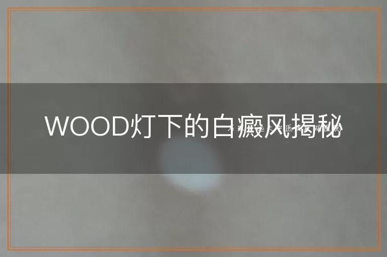 WOOD灯下的白癜风揭秘
