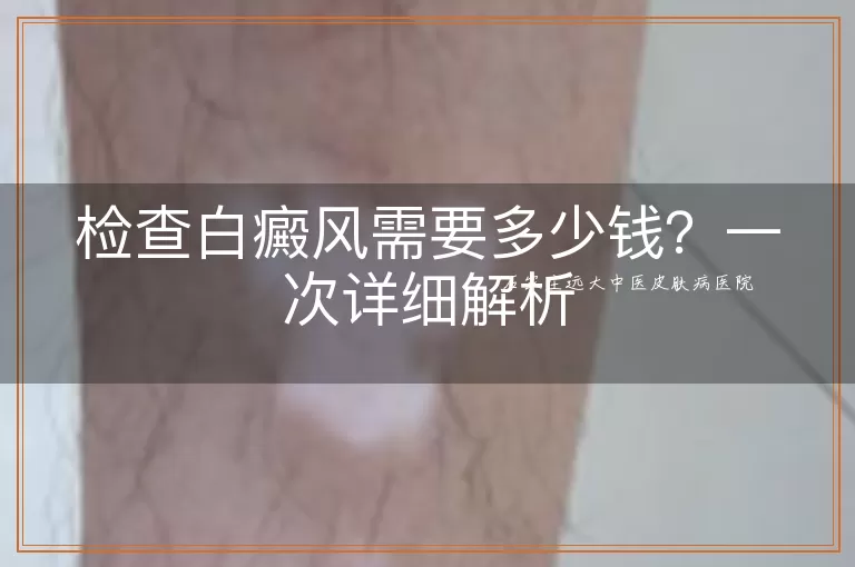 检查白癜风需要多少钱?一次详细解析