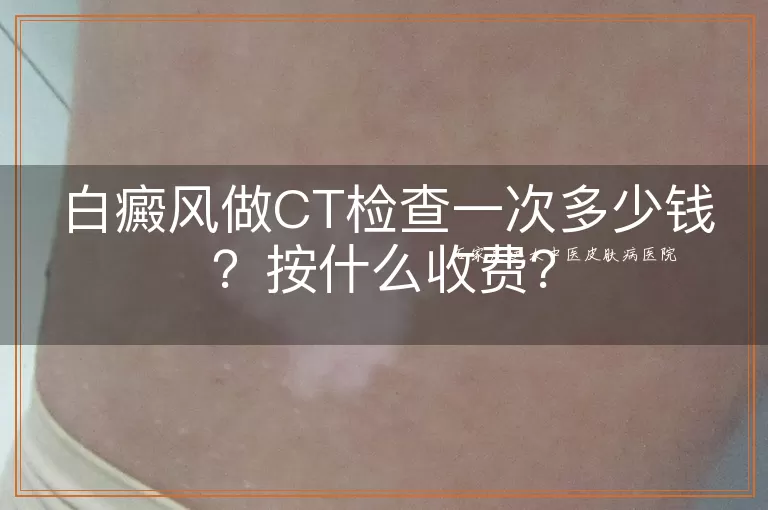 白癜风做CT检查一次多少钱？按什么收费？