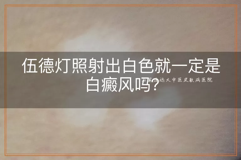 伍德灯照射出白色就一定是白癜风吗？