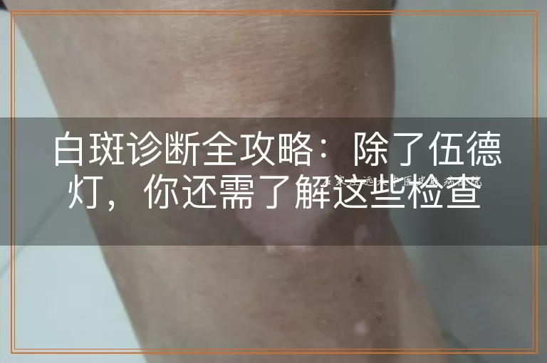 白斑诊断全攻略：除了伍德灯，你还需了解这些检查