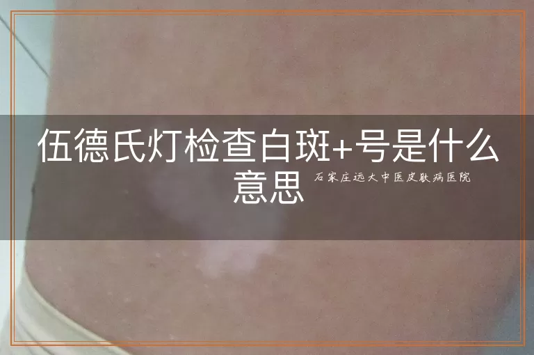 伍德氏灯检查白斑+号是什么意思
