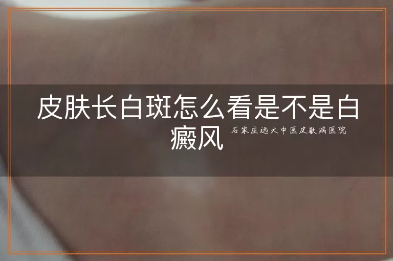 皮肤长白斑怎么看是不是白癜风