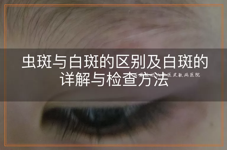虫斑与白斑的区别及白斑的详解与检查方法