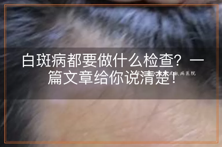 白斑病都要做什么检查？一篇文章给你说清楚！
