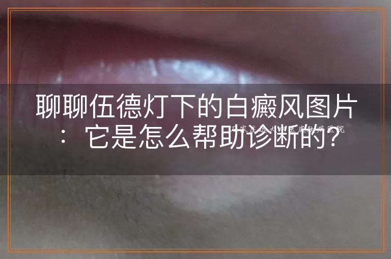 聊聊伍德灯下的白癜风图片：它是怎么帮助诊断的？
