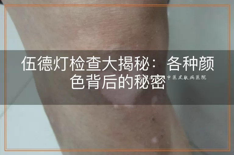 伍德灯检查大揭秘：各种颜色背后的秘密