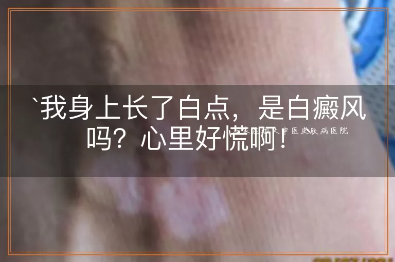 我身上长了白点，是白癜风吗？心里好慌啊！