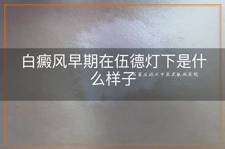 白癜风早期在伍德灯下是什么样子
