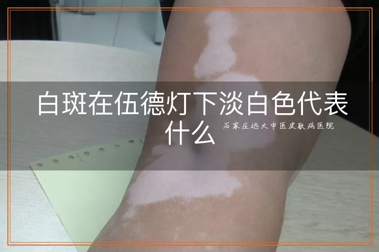 白斑在伍德灯下淡白色代表什么