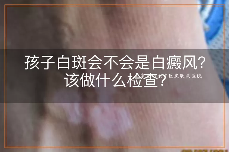 孩子白斑会不会是白癜风？该做什么检查？