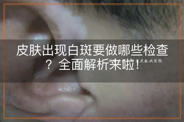 皮肤出现白斑要做哪些检查？全面解析来啦！
