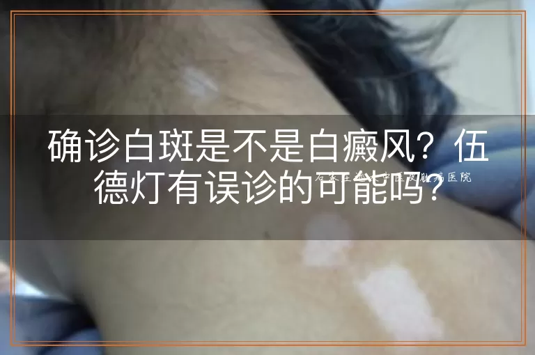 确诊白斑是不是白癜风？伍德灯有误诊的可能吗？