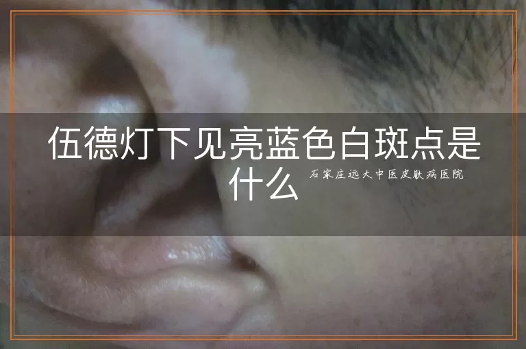 伍德灯下见亮蓝色白斑点是什么