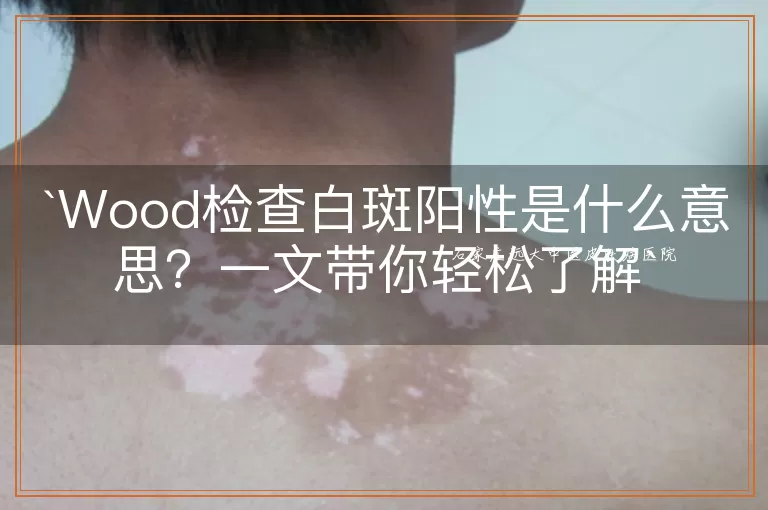 Wood检查白斑阳性是什么意思？一文带你轻松了解