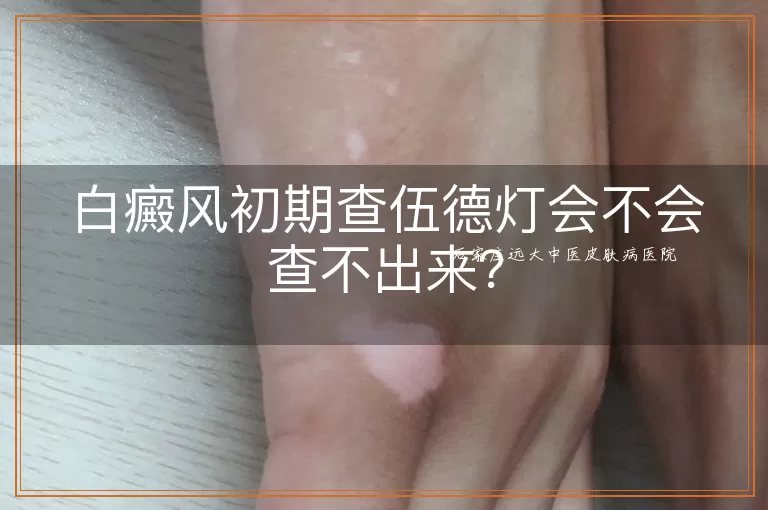 白癜风初期查伍德灯会不会查不出来？