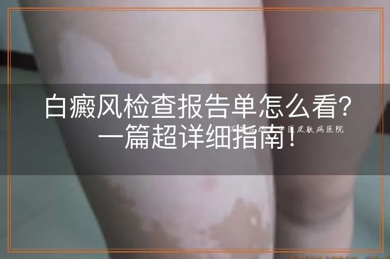 白癜风检查报告单怎么看？一篇超详细指南！