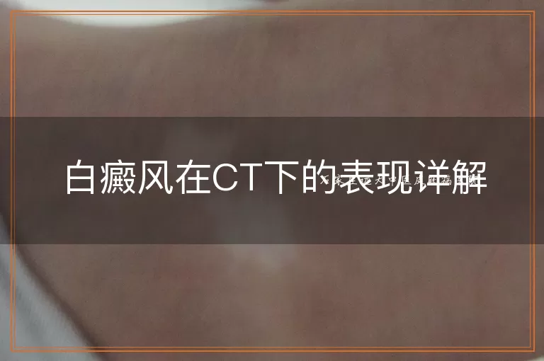 白癜风在CT下的表现详解