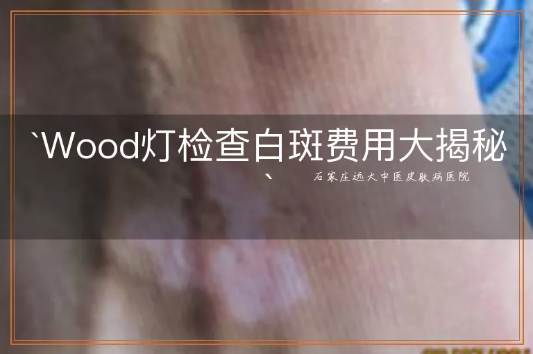 Wood灯检查白斑费用大揭秘
