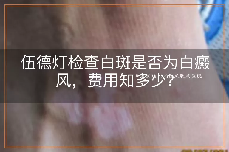 伍德灯检查白斑是否为白癜风，费用知多少？