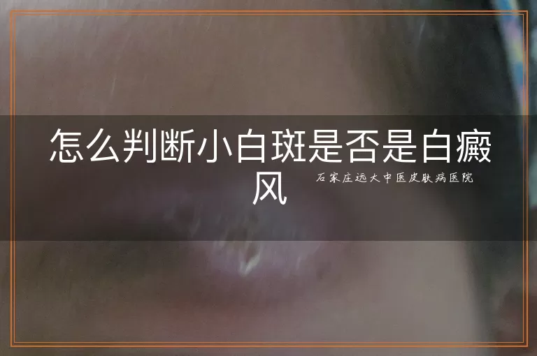 怎么判断小白斑是否是白癜风