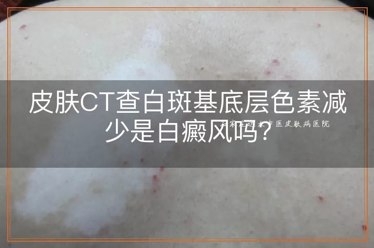皮肤CT查白斑基底层色素减少是白癜风吗？