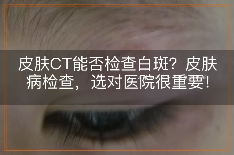 皮肤CT能否检查白斑？皮肤病检查，选对医院很重要！
