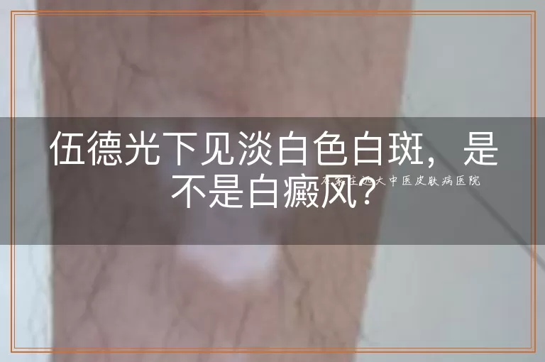 伍德光下见淡白色白斑，是不是白癜风？