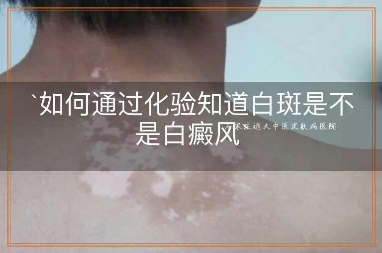 如何通过化验知道白斑是不是白癜风