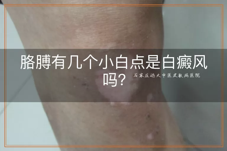 胳膊有几个小白点是白癜风吗?