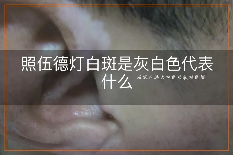照伍德灯白斑是灰白色代表什么