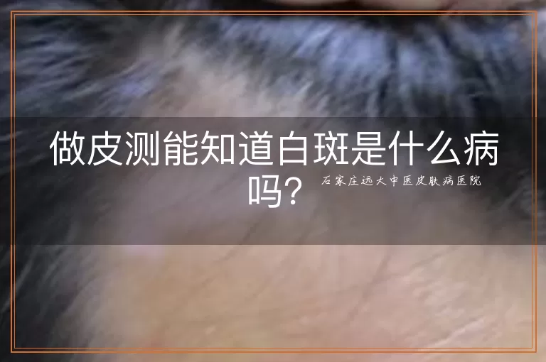 做皮测能知道白斑是什么病吗？