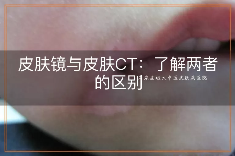 皮肤镜与皮肤CT：了解两者的区别