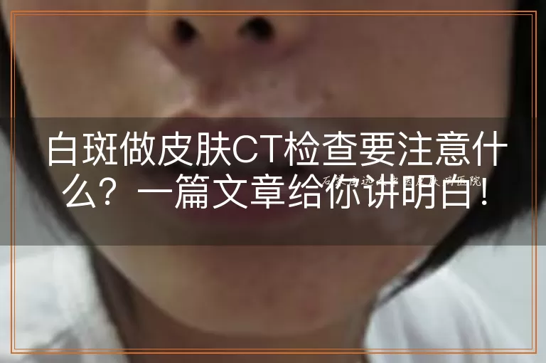 白斑做皮肤CT检查要注意什么？一篇文章给你讲明白！