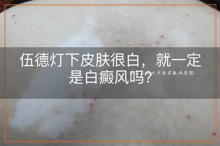 伍德灯下皮肤很白，就一定是白癜风吗？