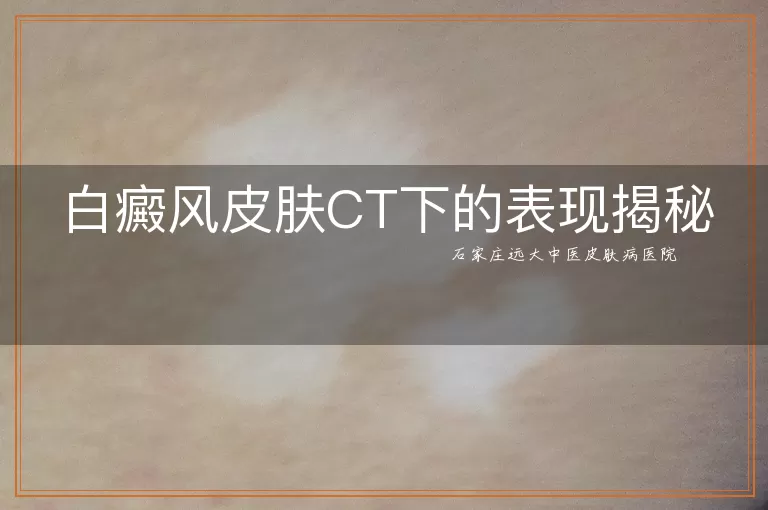白癜风皮肤CT下的表现揭秘