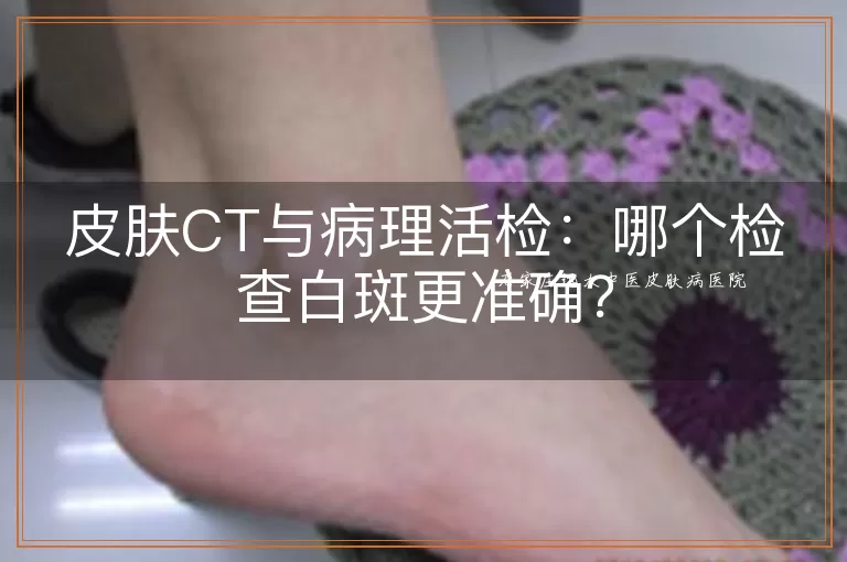 皮肤CT与病理活检：哪个检查白斑更准确？