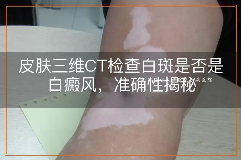 皮肤三维CT检查白斑是否是白癜风，准确性揭秘